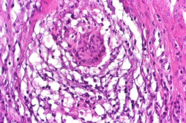 Tejido afectado por la enfermedad de Crohn. / Wikimedia Commons