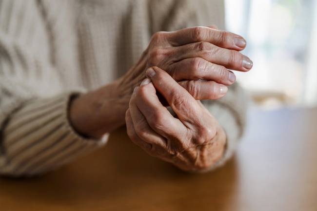 Manos de una persona con artritis reumatoide