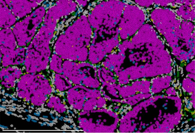 cáncer de mama, gen, metástasis