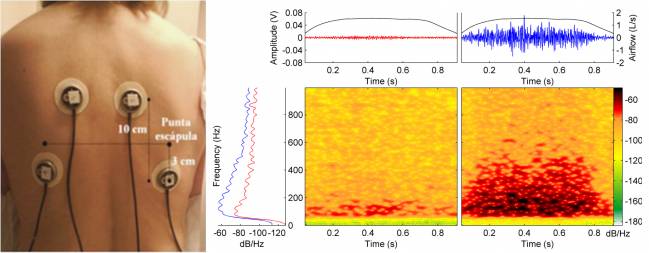 Gráfico que muestra la intensidad del sonido respiratorio en ambos lados de un paciente con parálisis unilateral, con el lado paralizado a la izquierda. / IBEC