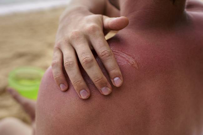 Una persona aplicando crema solar en piel quemada. 
