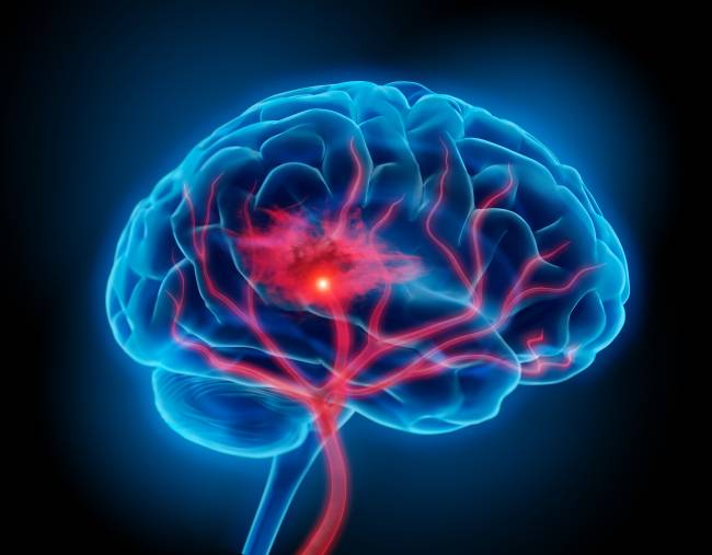 accidente cerebrovascular