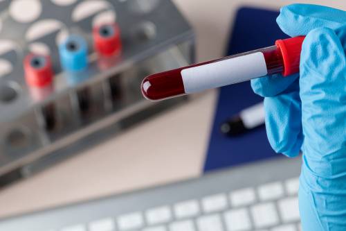 Cirujano sostine una muestra de sangre en un tubo