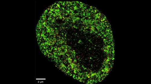 Imagen microscópica de una célula cancerosa 