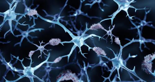 Agregados de placas amiloides en la enfermedad del Alzheimer
