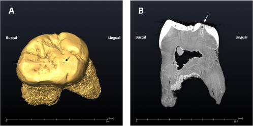 Dientes neandertal