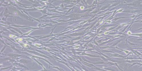 El ‘escudo’ que usa un cáncer de hígado agresivo para resistir la quimioterapia