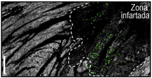 neutrófilos, daño cardiaco, infarto