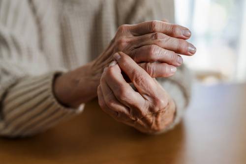 Manos de una persona con artritis reumatoide