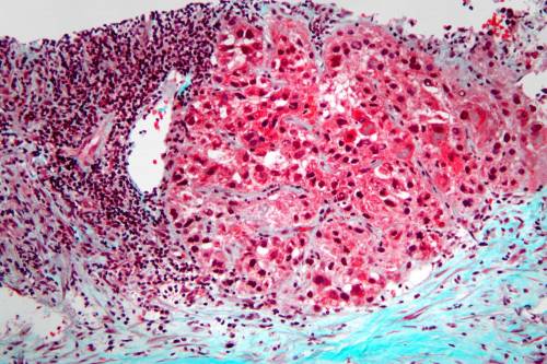 Imagen microscópica de un carcinoma hepatocelular