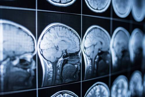 Neuroimágenes de cerebros.