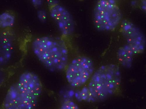 Imagen de un grupo de células tumorales pulmonares con aumento de KRAS para superar la barrera natural Capicua. / CIC