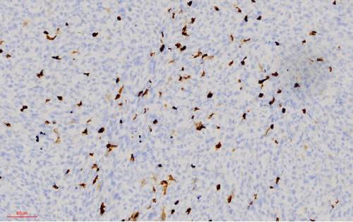 Infiltración de células del sistema inmunológico 