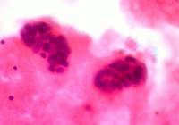 Desciende la incidencia del cáncer de mama en España 