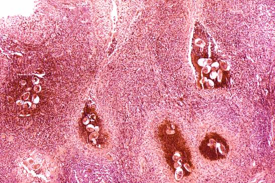 Descrito un nuevo método de diagnóstico para la esquistosomiasis