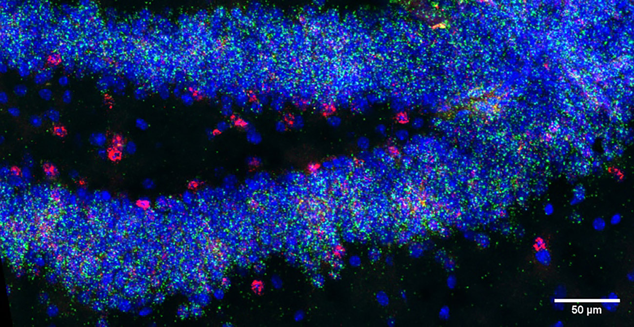 Descubren un gen clave en los déficits de memoria y aprendizaje del síndrome de Down