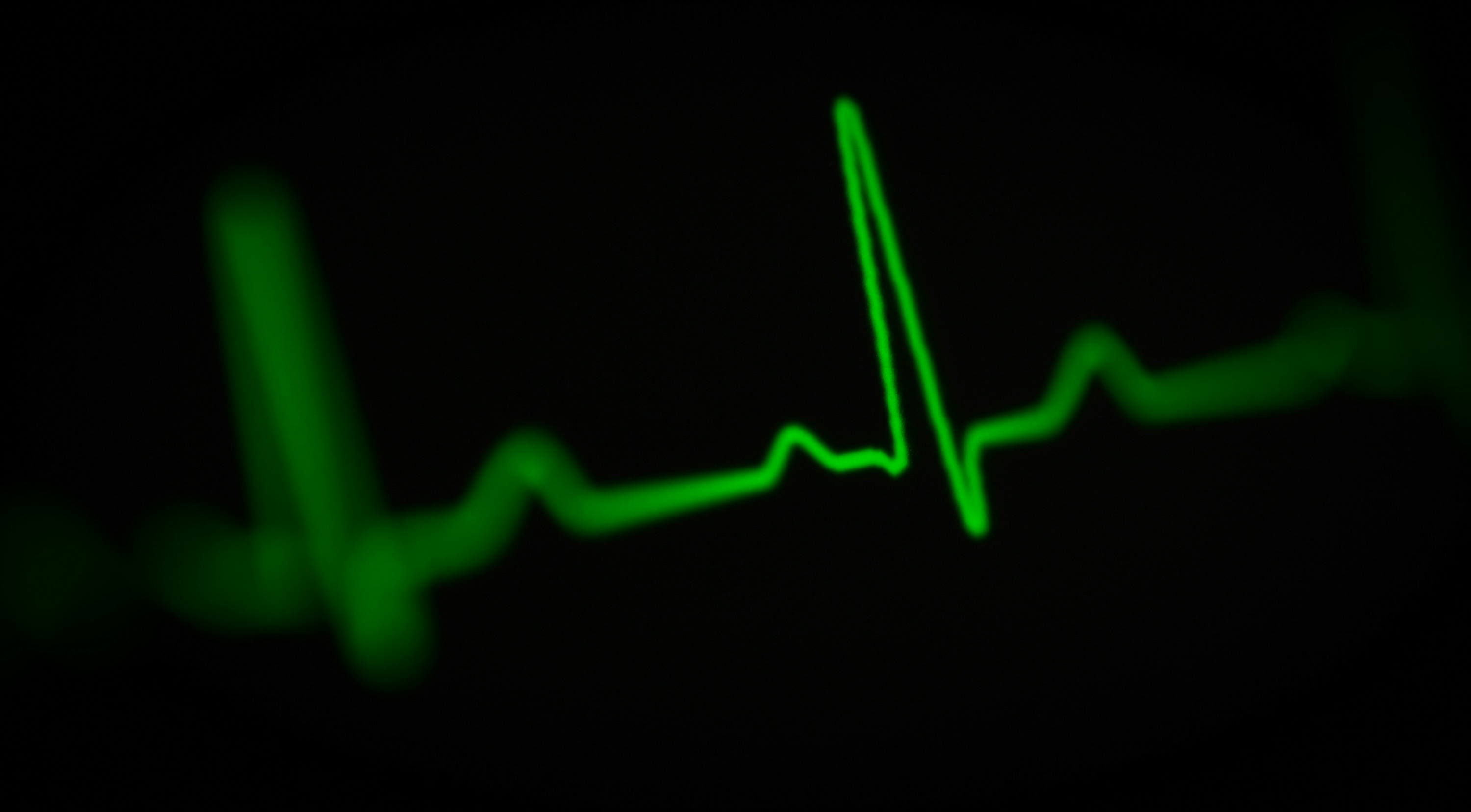 Hallan un mayor nivel de microplásticos en el corazón de pacientes infartados