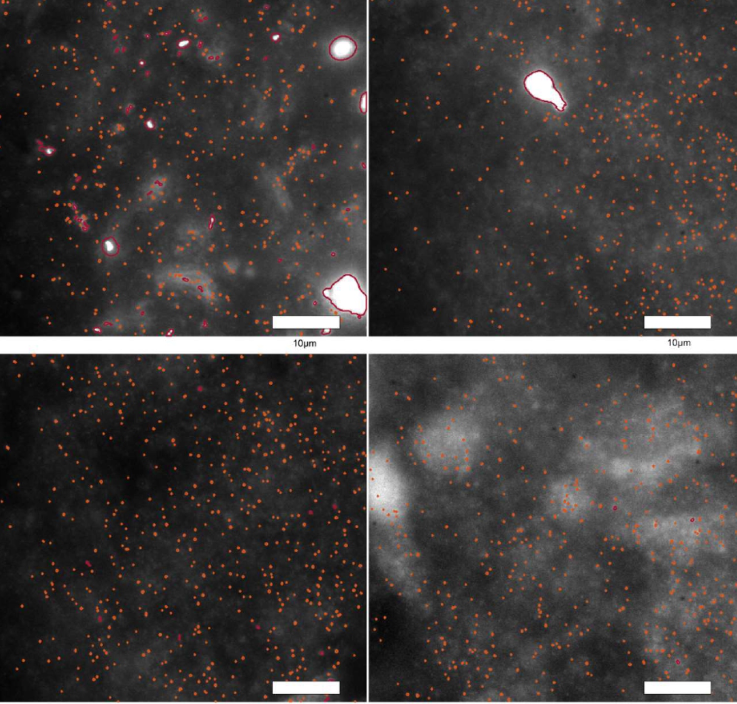 Observan por primera vez las ‘primeras huellas’ del párkinson en tejido cerebral