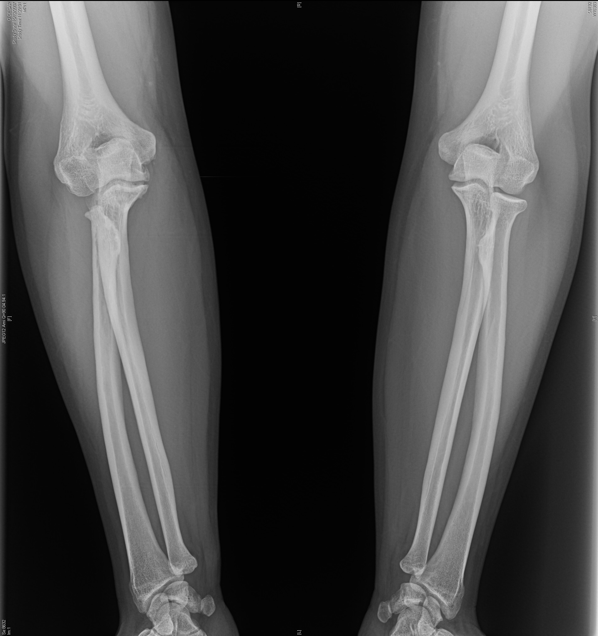 Anatomía Radiográfica Del Codo