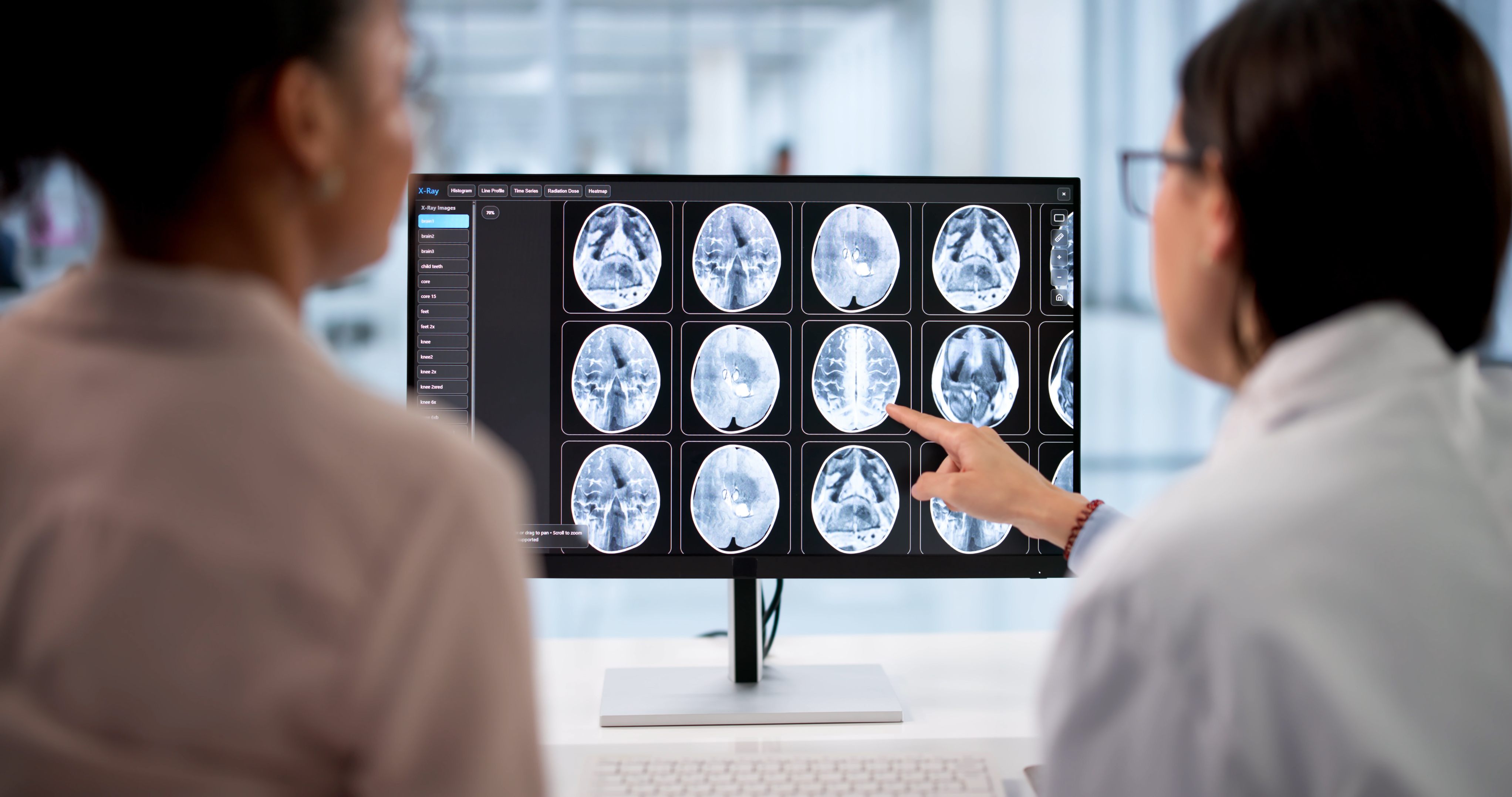 Un análisis de sangre y un nuevo escáner cerebral detectan señales de alzhéimer años antes de los síntomas