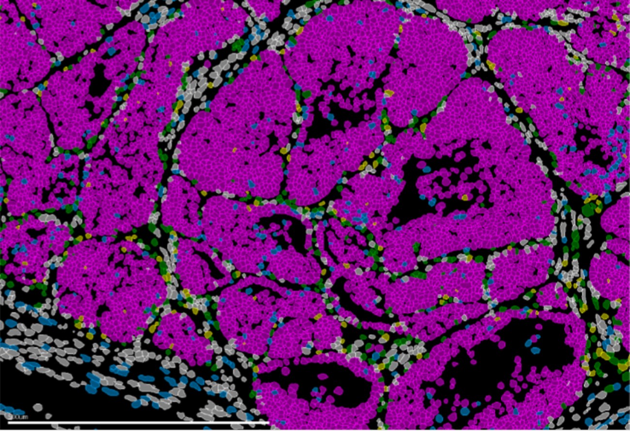 Un gen controla si las células del cáncer de mama se diseminan o permanecen dormidas
